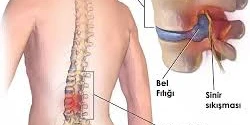 Bel Fıtığının Ameliyatsız Tedavisi Mümkün...